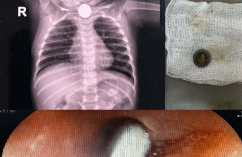 Extracción de cuerpos extraños